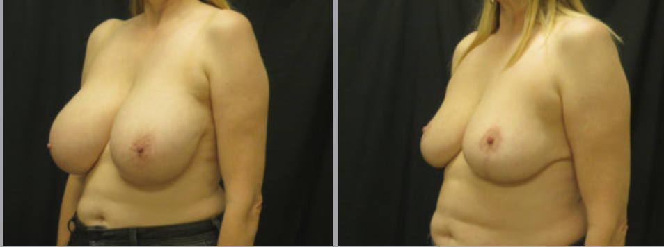 Breast Reduction in Ventura, CA